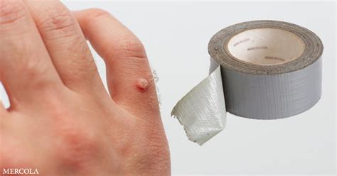 Wart Removal With Duct Tape: Easy Solution