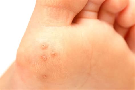 Warts On Childrens Feet