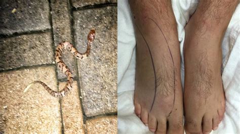 Water Moccasin Bite Symptoms