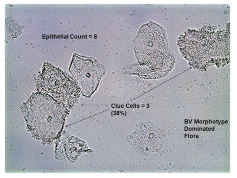 Wet Prep Clue Cells