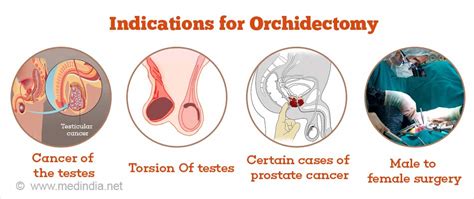 What Are Orchiectomy Side Effects? Managing Symptoms