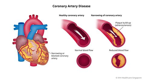 What Are The Main Causes Of Coronary Artery Disease Pelajaran