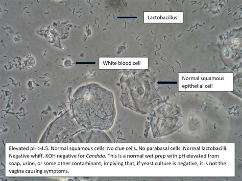 What Are Wbcs On Wet Mount? Accurate Diagnosis