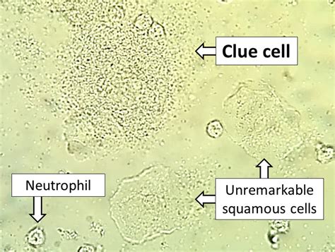 What Are Wet Mount Clue Cells? Diagnosis Guide