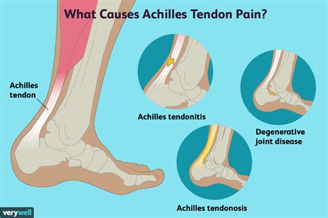 What Causes Achilles Tendon Pain? Quick Relief