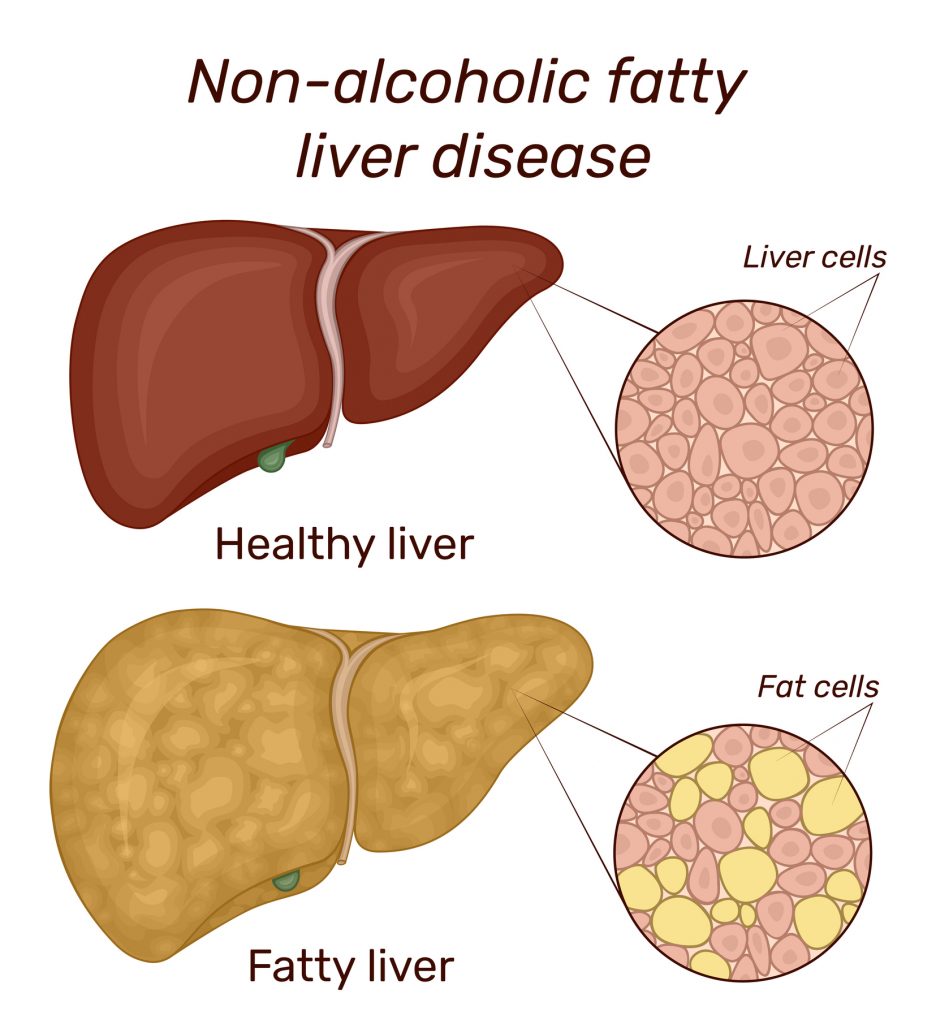 What Causes Alcoholic Liver? Diagnosis Guide