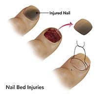 What Causes Avulsion Of Nail Bed? Healing Tips