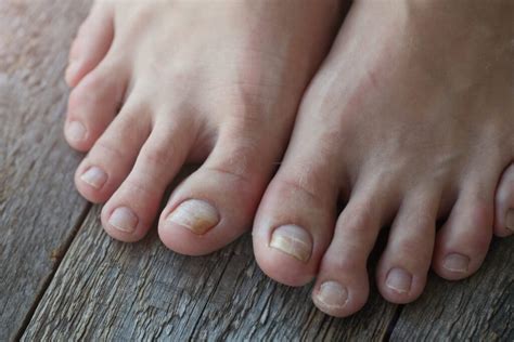 What Causes Broken Nail Toe? Fix It Fast