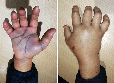 What Causes Bruise On Hand Palm? Fast Relief