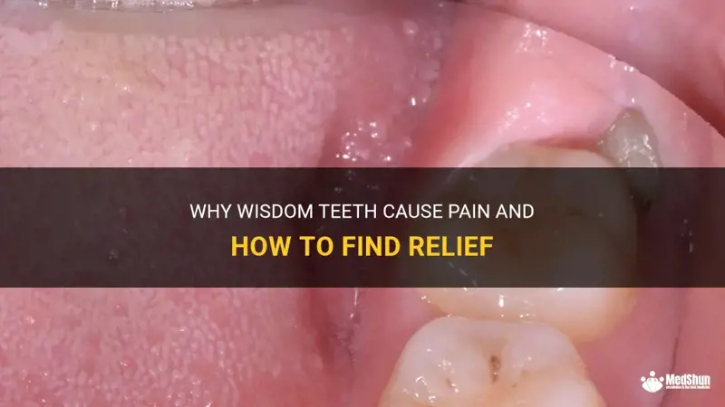 What Causes Clot After Wisdom Teeth? Heal Faster