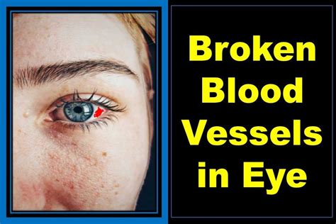 What Causes Eye Vessel Breaks? Easy Fixes