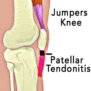 What Causes Jumper's Knee? Relief Stretches