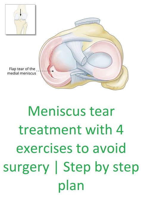 What Causes Medial Meniscus Tear? Healing Exercises