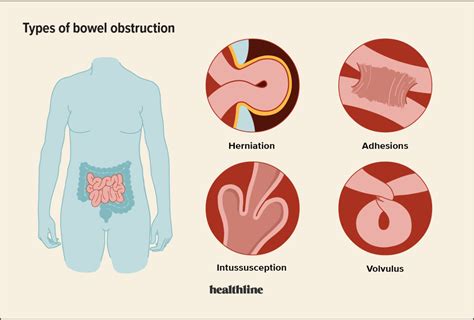 What Causes Pediatric Bowel Obstruction? Symptoms Guide