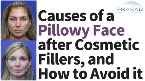 What Causes Pillow Face From Fillers And How To Avoid It