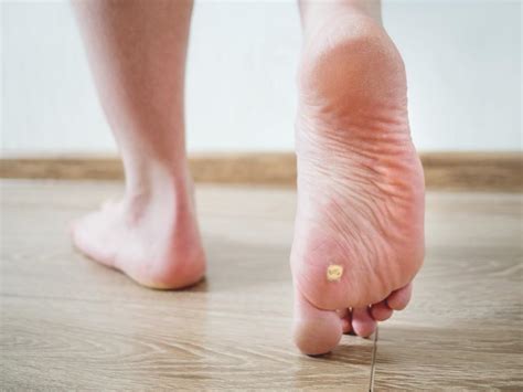 What Causes Plantar Warts Bryon Butts Dpm Podiatrist