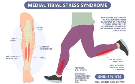 What Causes Shin Splints Vs Stress Fracture?