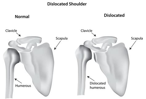 What Causes Shoulder Dislocates? Fix Your Form