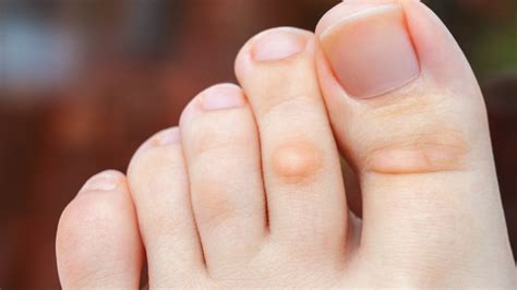 What Causes Soft Corn Between Toes? Easy Relief