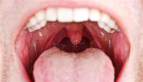 What Does A Normal Healthy Throat Look Like