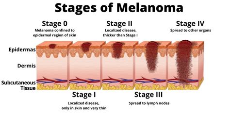 What Each Melanoma Stage Means