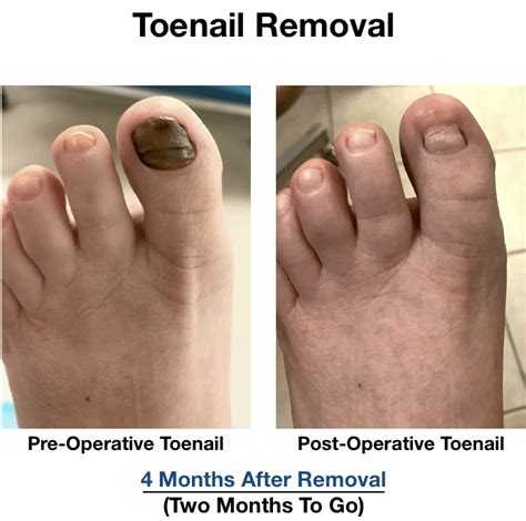 What Happens After Toenail Removal? Healing Tips