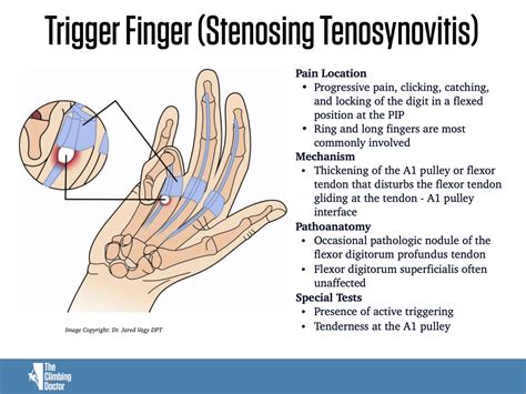 What Is A Differential Diagnosis Of Trigger Finger