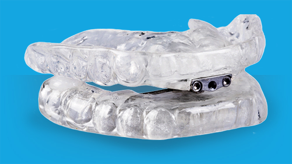 What Is A Mandibular Advancement Device Myofunctional Therapy