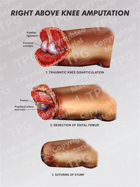 What Is Above Knee Amputation? Recovery Guide