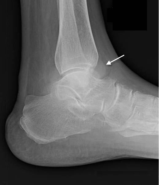 What Is Ankle Joint Effusion Capitol Imaging Services