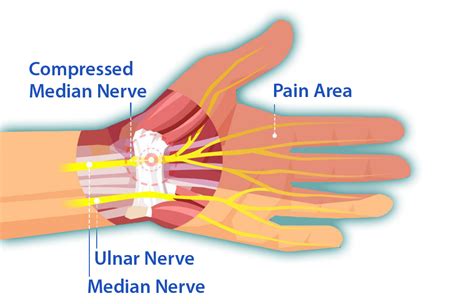 What Is Carpal Tunnel Syndrome Understanding And Treating Cts