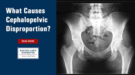 What Is Cephalopelvic Disproportion? Diagnosis Help