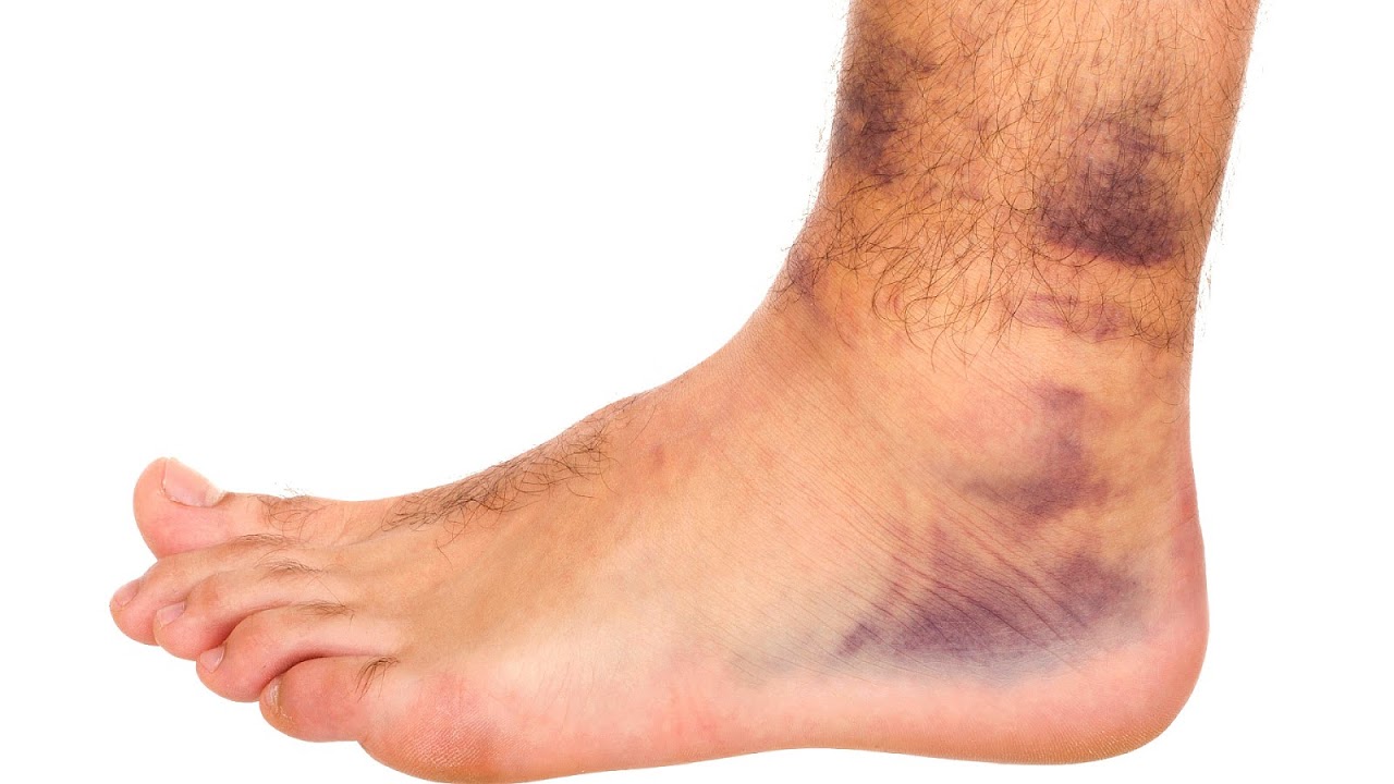 What Is Contusion Injury