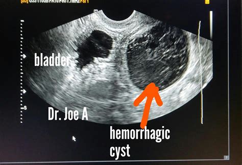 What Is Hemorrhagic Cyst