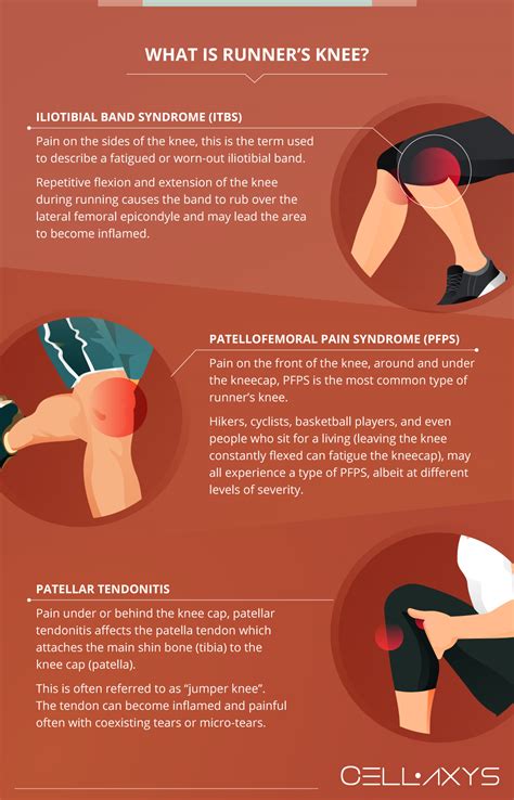 What Is Runner S Knee Patellofemoral Pain Syndrome Knee Pain Relief