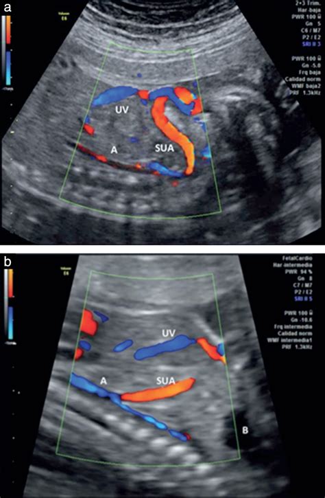 What Is Single Artery Umbilical Cord? Risks Explained