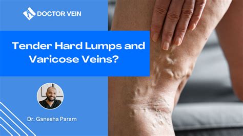 What Is The Hard Lump On The Varicose Vein Vein Center Doctor