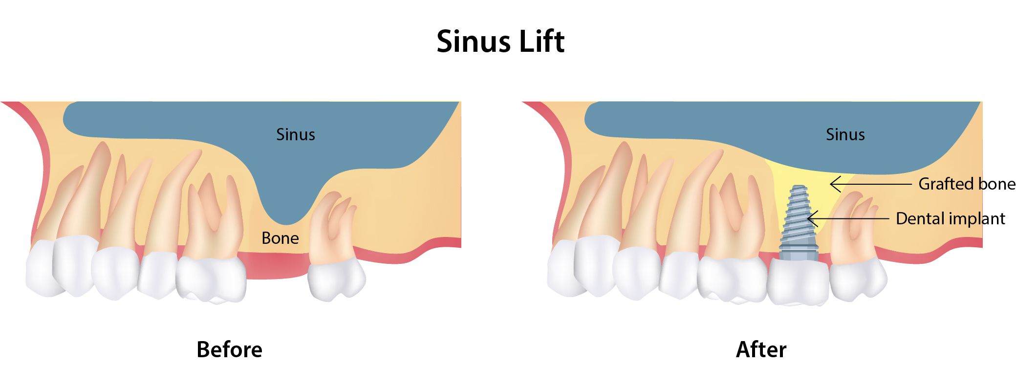 What Is The Recovery Time After Sinus Surgery