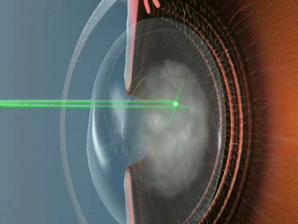 What Is Yag Capsulotomy? Clear Vision Guaranteed