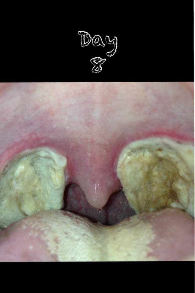 What To Expect After A Tonsillectomy