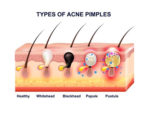 What's Cyst Vs Pimple? Know Difference