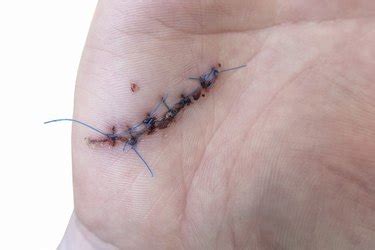 When Do Stitches Heal Fast? Expert Recovery Tips