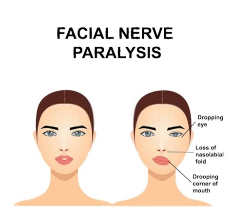 When Does Bells Palsy Bradycardia Occur? Treatment Tips