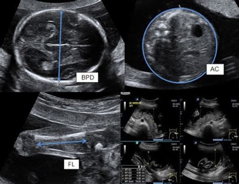 When Is 38 Weeks Newborn Ready? Health Checks