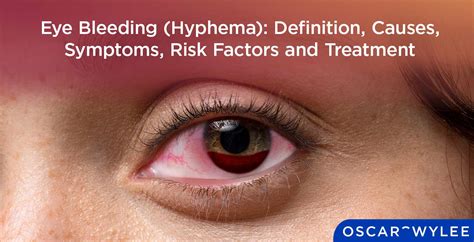 When Is Bleeding Behind Eye Serious? Know Symptoms