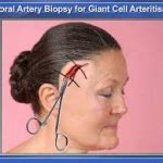 When Is Temporal Artery Biopsy Necessary? Symptoms Help