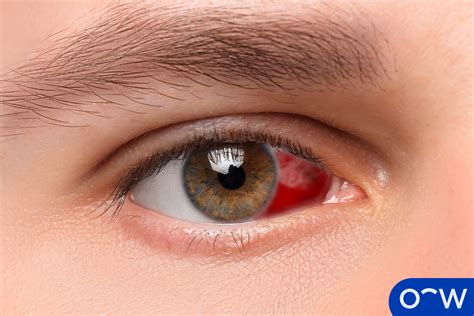 When To Be Concerned About A Bleeding Eye