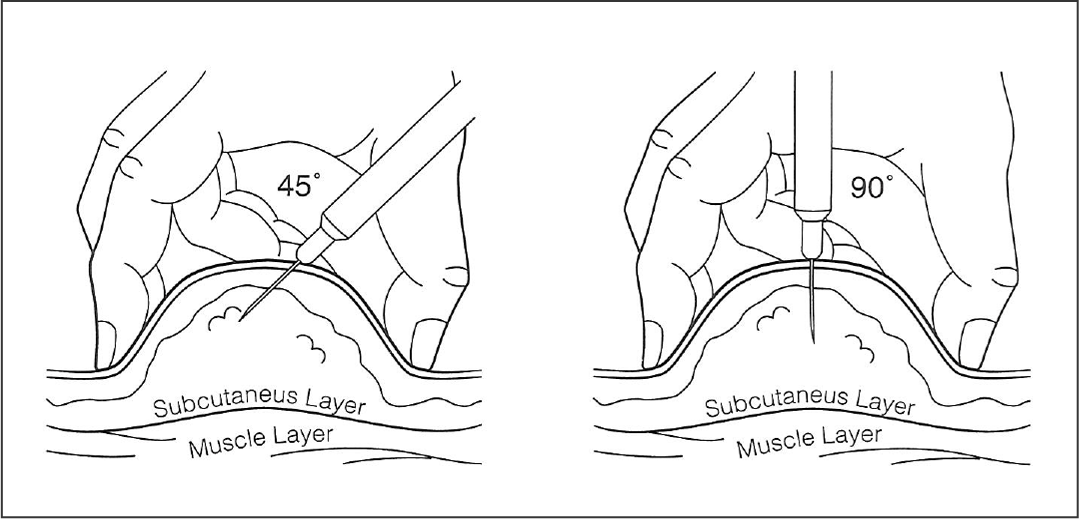 When To Use Subcutaneous Injection Sites? Expert Tips