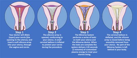 Womb Ablation Recovery