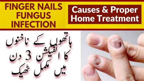 Worst Finger Nail Fungus Infection Home Treatment Cure Fingernail